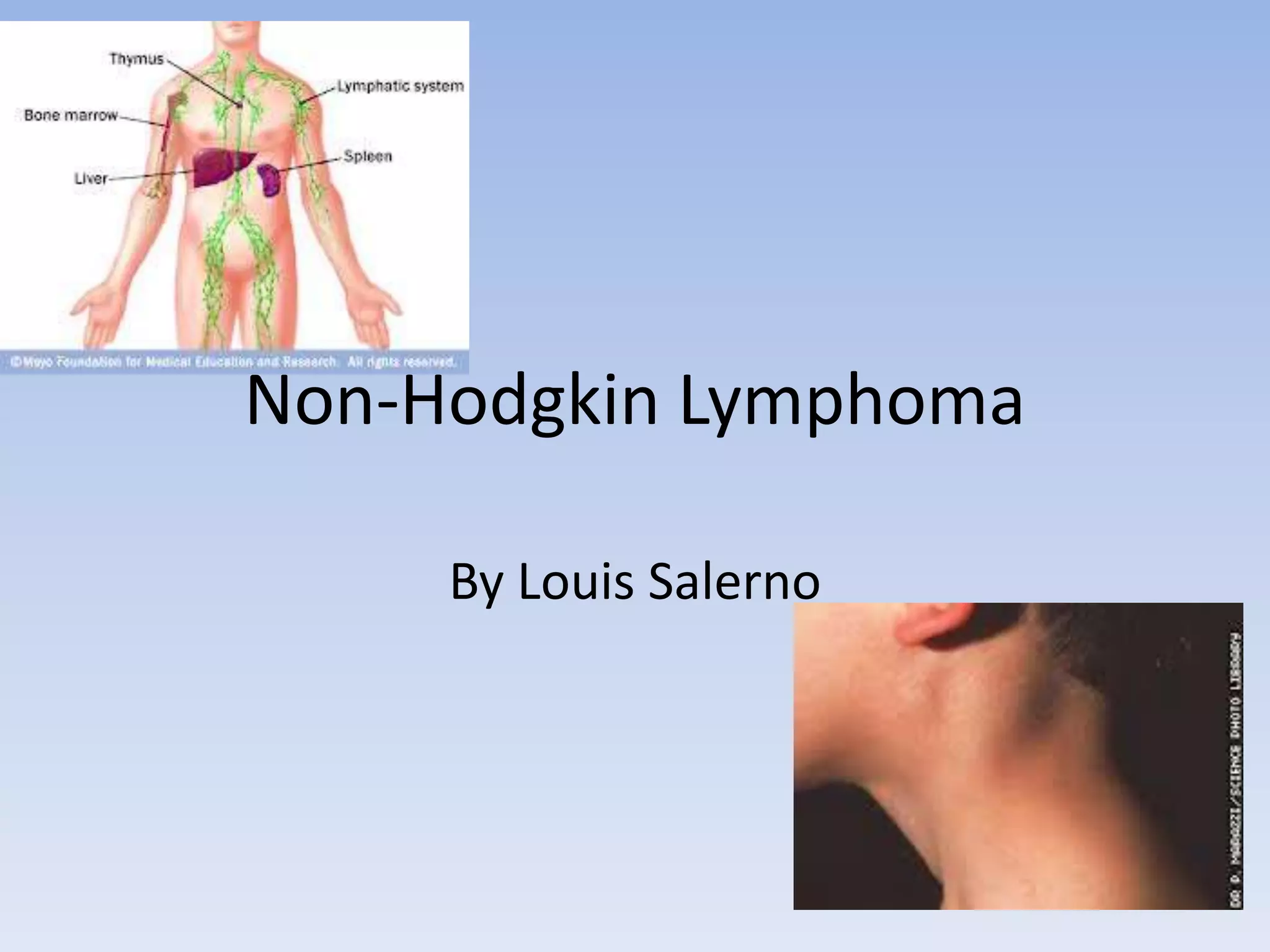 Non hodgkin lymphoma | PPTX
