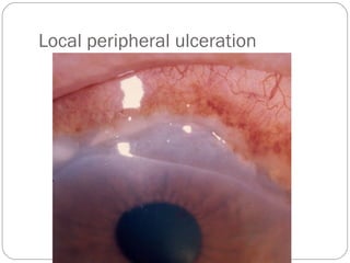 Local peripheral ulceration
 