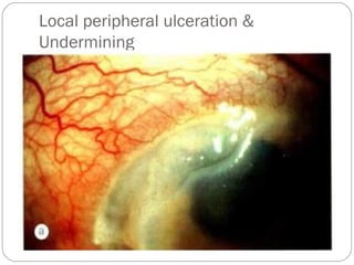 Local peripheral ulceration &
Undermining
 