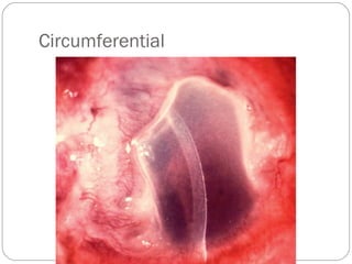 Circumferential
 