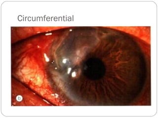 Circumferential
 