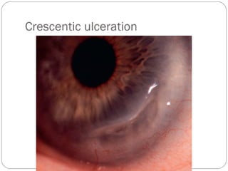 Crescentic ulceration
 
