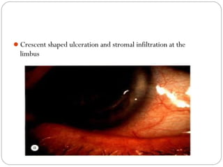Crescent shaped ulceration and stromal infiltration at the
limbus
 