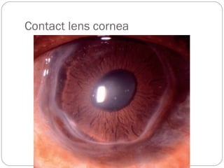 Contact lens cornea
 