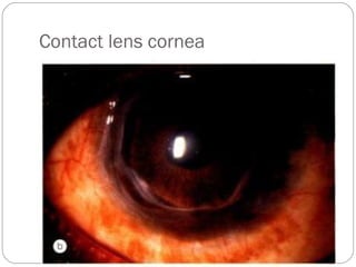 Contact lens cornea
 