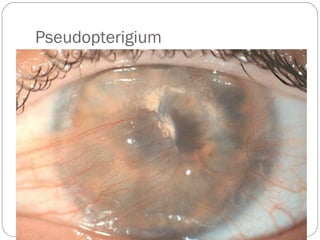 Pseudopterigium
 