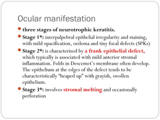 Ocular manifestation
three stages of neurotrophic keratitis.
Stage 1*: interpalpebral epithelial irregularity and staining,
with mild opacification, oedema and tiny focal defects (SPKs)
Stage 2*: is characterized by a frank epithelial defect,
which typically is associated with mild anterior stromal
inflammation. Folds in Descemet’s membrane often develop.
The epithelium at the edges of the defect tends to be
characteristically “heaped up” with grayish, swollen
epithelium.
Stage 3*: involves stromal melting and occasionally
perforation
 