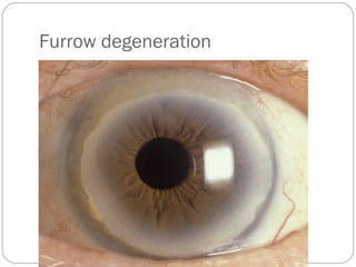 Furrow degeneration
 