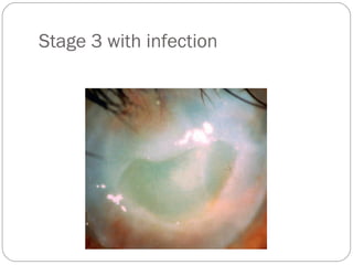 Stage 3 with infection
 