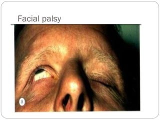 Facial palsy
 