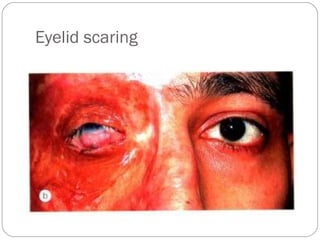 Eyelid scaring
 