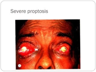Severe proptosis
 