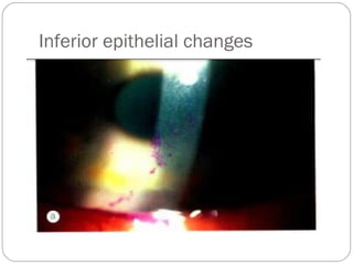 Inferior epithelial changes
 