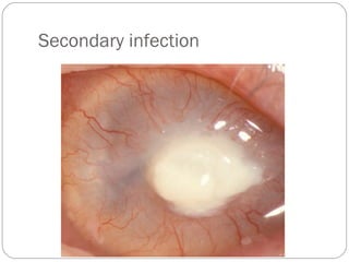 Secondary infection
 