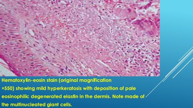 xanthogranuloma treatment skin Non the of infectious&necrobiotic diseases granulomatous