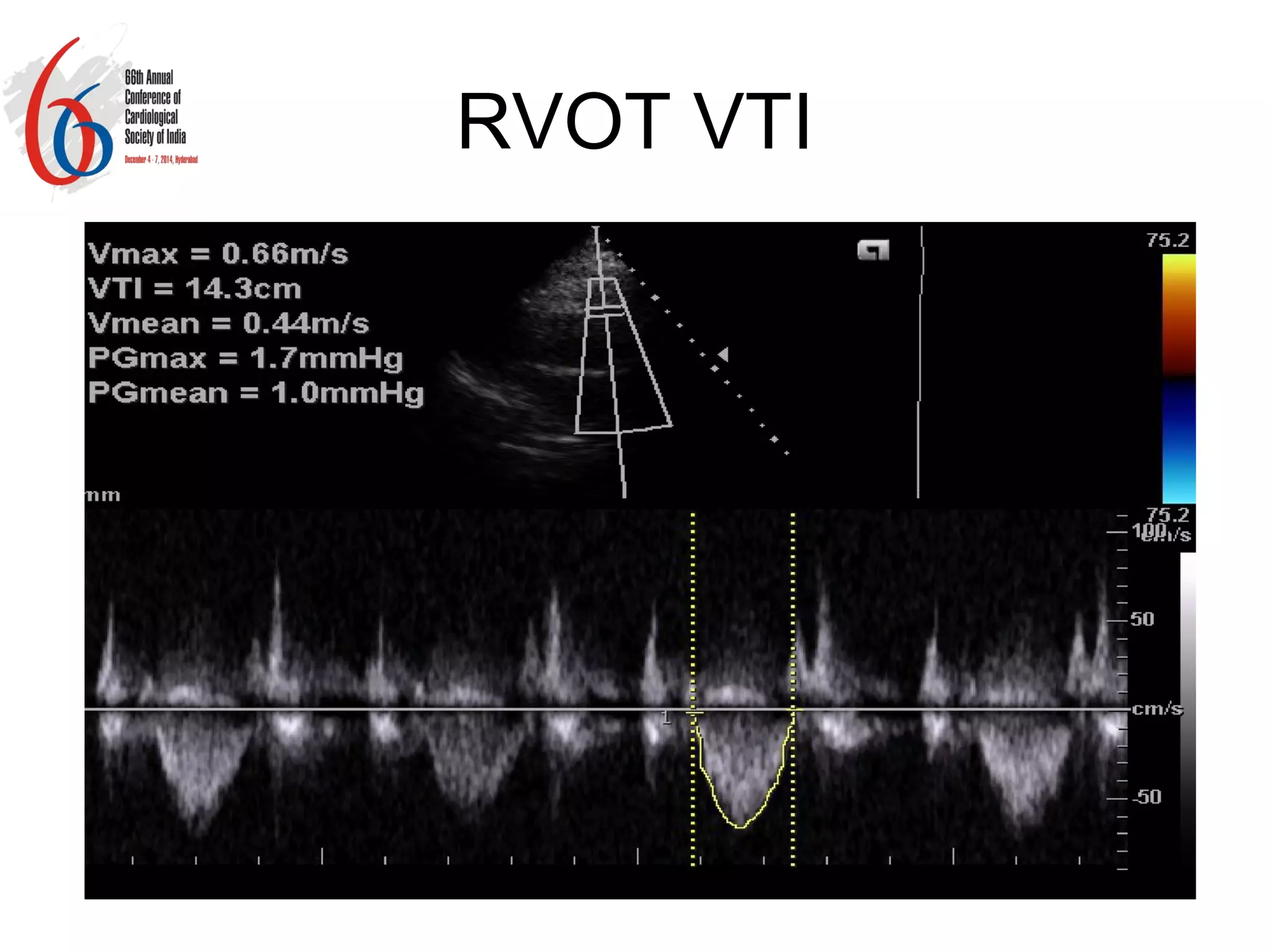 Non invasive estimation of pulmonary vascular resistance in patients of ...