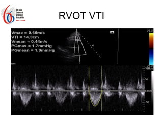 Pv Rsvti Non invasive estimation of pulmonary vascular resistance in patients of ...