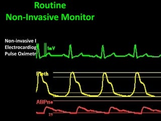 Non-invasive Blood Pressure (NIBP)
Electrocardiography (ECG)
Pulse Oximetry (SpO2)
Routine
Non-Invasive Monitor
 