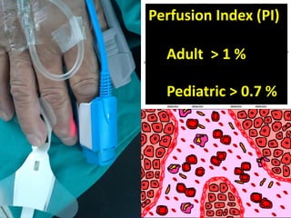 Perfusion Index (PI)
Adult > 1 %
Pediatric > 0.7 %
 
