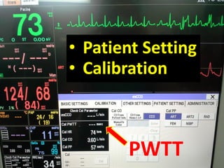 • Patient Setting
• Calibration
PWTT
 