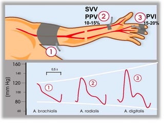 SVV
PPV
10-15%
PVI
15-20%
 