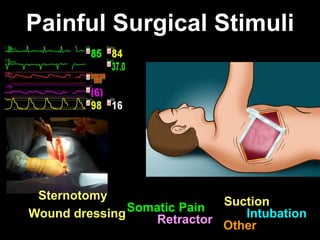Painful Surgical Stimuli
Sternotomy SuctionSomatic PainWound dressing IntubationRetractor Other
 