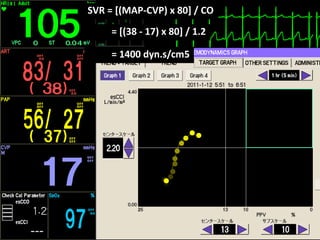 ●
●●
●
●
●
●
●
●
●
●
●
= [(38 - 17) x 80] / 1.2
= 1400 dyn.s/cm5
SVR = [(MAP-CVP) x 80] / CO
 