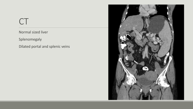 Imaging of portal hypertension | PPTX | Blood Disorders | Diseases and ...