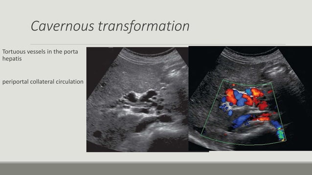 Imaging of portal hypertension | PPTX | Blood Disorders | Diseases and ...