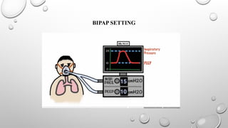 BIPAP SETTING
 