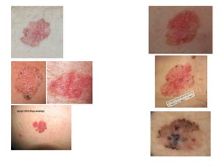 Non melanoma skin cancers | PDF