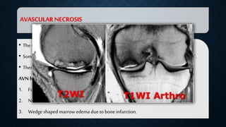 Radiological study of non meniscal knee joint pathology by dr ...