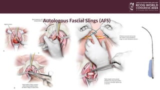 Non-Mesh surgery for Stress Urinary Incontinence | PPTX