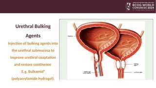 Non-Mesh surgery for Stress Urinary Incontinence | PPTX