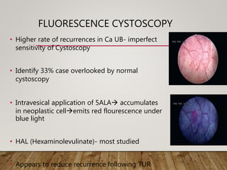 FLUORESCENCE CYSTOSCOPY
• Higher rate of recurrences in Ca UB- imperfect
sensitivity of Cystoscopy
• Identify 33% case overlooked by normal
cystoscopy
• Intravesical application of 5ALA accumulates
in neoplastic cellemits red flourescence under
blue light
• HAL (Hexaminolevulinate)- most studied
• Appears to reduce recurrence following TUR
 