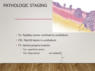 PATHOLOGIC STAGING
• Ta- Papillary tumor confined to urothelium
• CIS- Flat,HG lesion in urothelium
• T1- lamina propria invasion
• T1a- superficial Lamina
• T1b- Deep lamina not validated
 