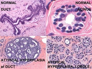 Normal Acinus Non neoplastic breast diseases | PPT