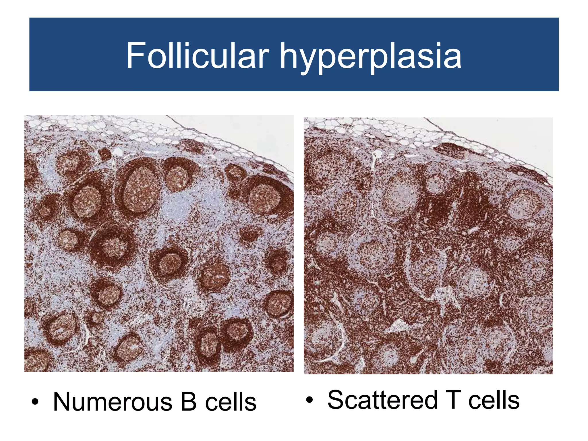 Non neoplastic lesions of lymph node | PPTX