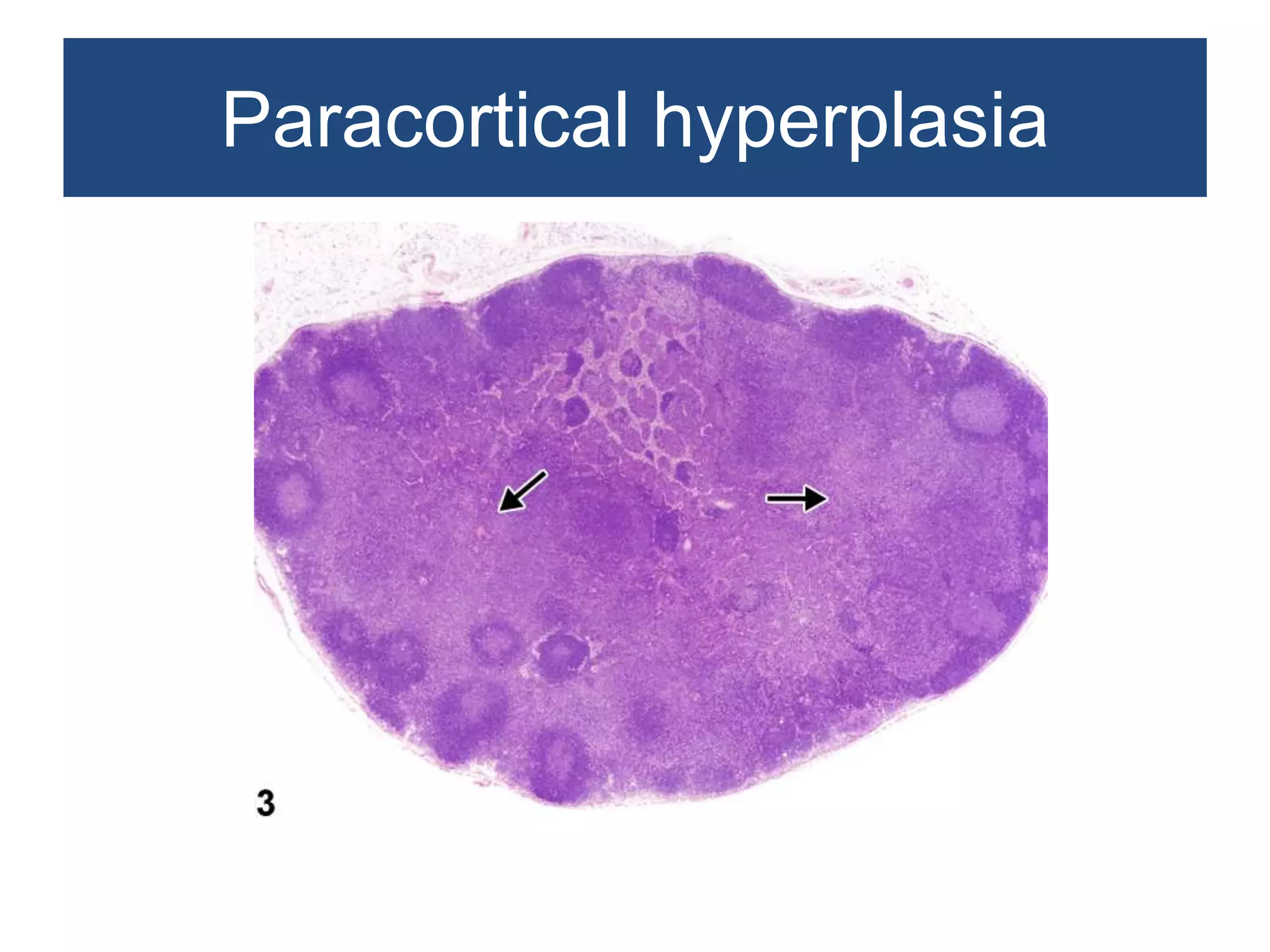 Non neoplastic lesions of lymph node | PPTX