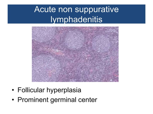 Non neoplastic lesions of lymph node | PPTX | Blood Disorders ...