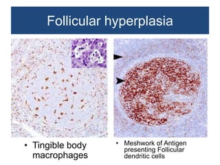 Non neoplastic lesions of lymph node | PPTX
