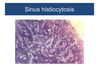 Non neoplastic lesions of lymph node | PPTX