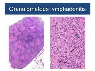 Non neoplastic lesions of lymph node | PPTX