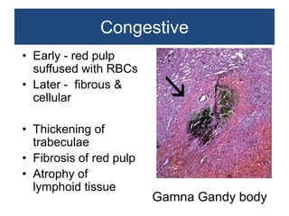 Non neoplastic lesions of lymph node | PPTX
