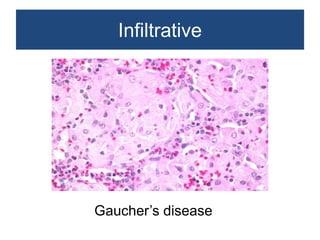 Non neoplastic lesions of lymph node | PPTX