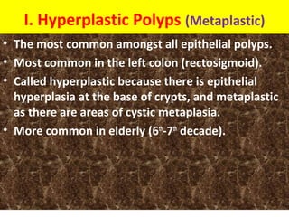 I. Hyperplastic Polyps (Metaplastic)
• The most common amongst all epithelial polyps.
• Most common in the left colon (rectosigmoid).
• Called hyperplastic because there is epithelial
hyperplasia at the base of crypts, and metaplastic
as there are areas of cystic metaplasia.
• More common in elderly (6th-7th decade).

 