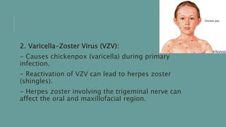 2. Varicella-Zoster Virus (VZV):
- Causes chickenpox (varicella) during primary
infection.
- Reactivation of VZV can lead to herpes zoster
(shingles).
- Herpes zoster involving the trigeminal nerve can
affect the oral and maxillofacial region.
 
