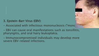 3. Epstein-Barr Virus (EBV):
- Associated with infectious mononucleosis ("mono").
- EBV can cause oral manifestations such as tonsillitis,
pharyngitis, and oral hairy leukoplakia.
- Immunocompromised individuals may develop more
severe EBV-related infections.
 