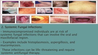 2. Systemic Fungal Infections:
- Immunocompromised individuals are at risk of
systemic fungal infections that can involve the oral and
maxillofacial region.
- Examples include histoplasmosis, aspergillosis, and
mucormycosis.
-These infections can be life-threatening and require
systemic antifungal therapy.
 