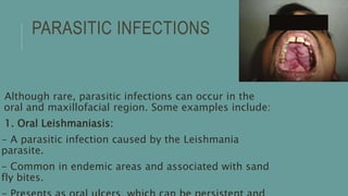 PARASITIC INFECTIONS
Although rare, parasitic infections can occur in the
oral and maxillofacial region. Some examples include:
1. Oral Leishmaniasis:
- A parasitic infection caused by the Leishmania
parasite.
- Common in endemic areas and associated with sand
fly bites.
 